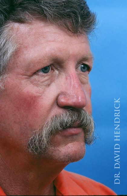 Neck Lift Before & After Patient #9014