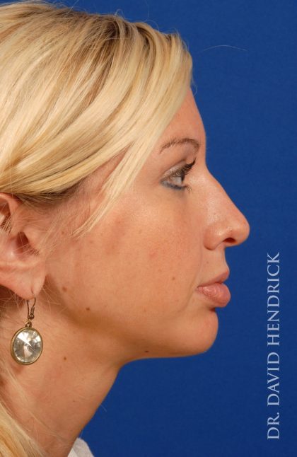 Face Implants Before & After Patient #8912