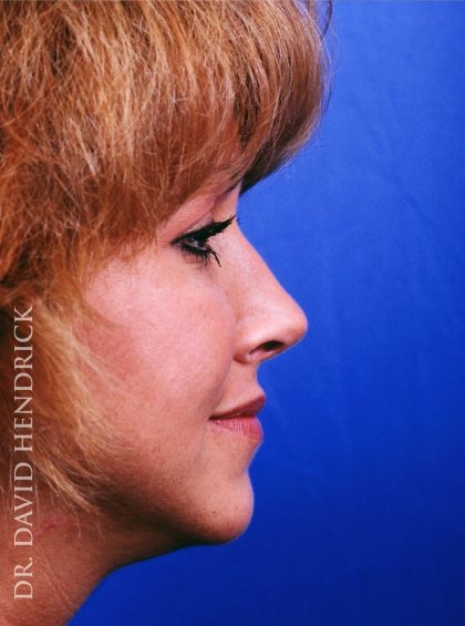 Rhinoplasty Before & After Patient #9019