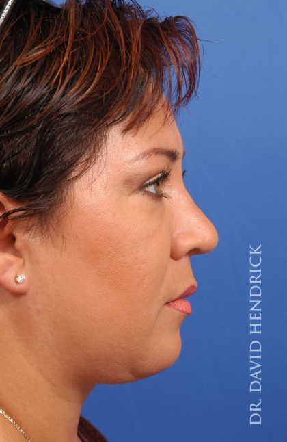 Face Implants Before & After Patient #8913