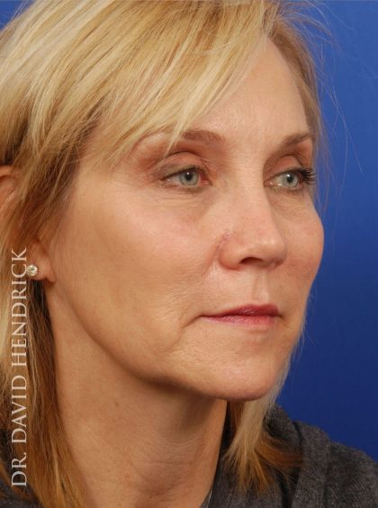 Deep Plane Facelift Before & After Patient #9026
