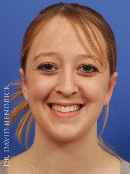 Otoplasty Before & After Patient #9031