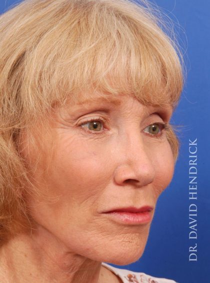 Face Implants Before & After Patient #8920