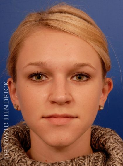 Otoplasty Before & After Patient #9038