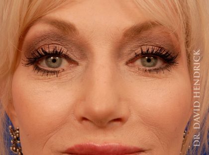 Deep Plane Facelift Before & After Patient #8936