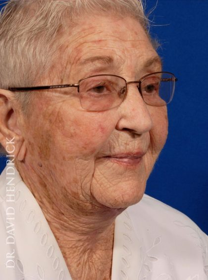 Neck Lift Before & After Patient #9052