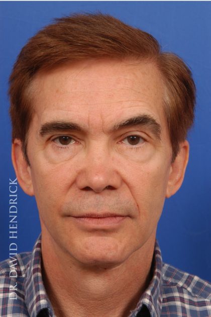 Facelift Before & After Patient #8873