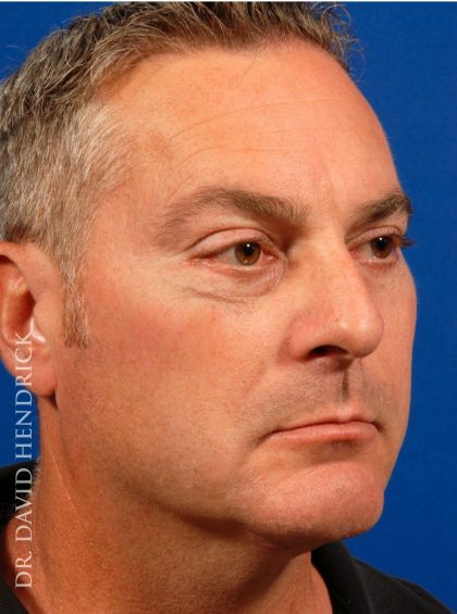 Face Implants Before & After Patient #8850