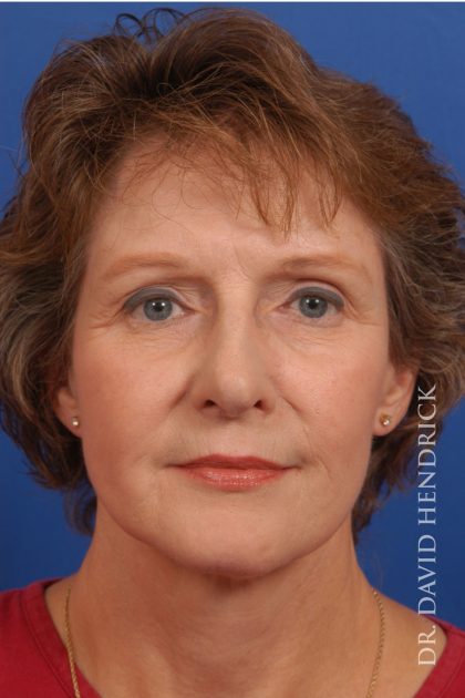 Facelift Before & After Patient #8847