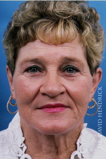 Facelift Before & After Patient #8840