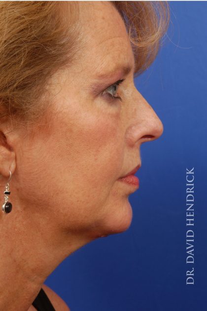 Face Implants Before & After Patient #8829