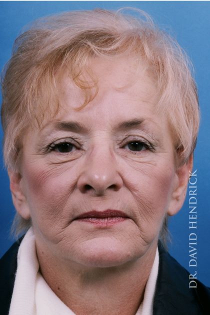 Facelift Before & After Patient #8819