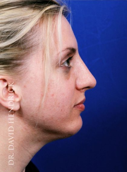 Face Implants Before & After Patient #8890