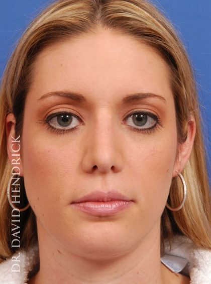 Face Implants Before & After Patient #8875