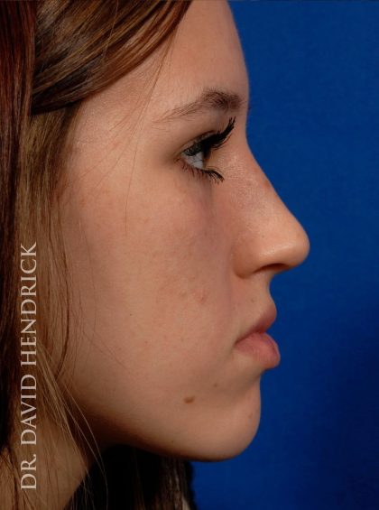 Rhinoplasty Before & After Patient #8948