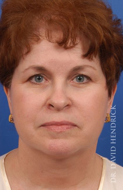 Facelift Before & After Patient #8857