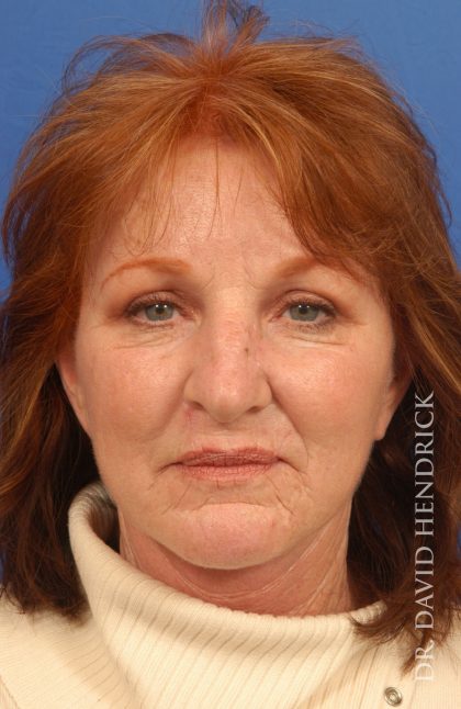 Facelift Before & After Patient #8859