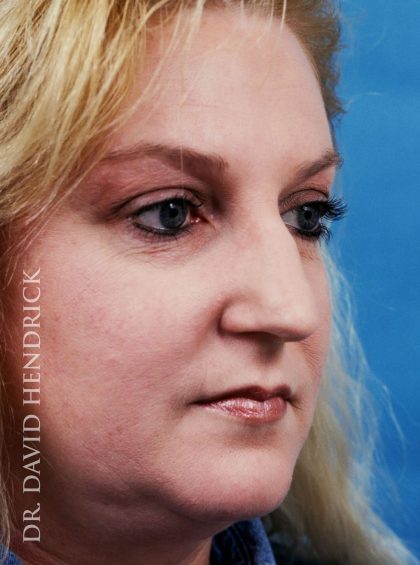 Rhinoplasty Before & After Patient #8967