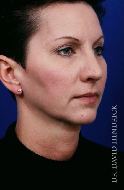 Face Implants Before & After Patient #8885