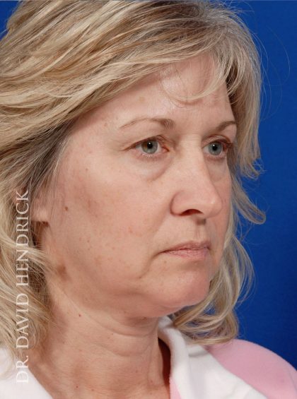 Deep Plane Facelift Before & After Patient #8974