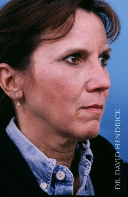 Facelift Before & After Patient #8895