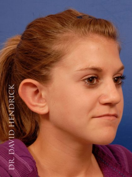 Otoplasty Before & After Patient #8988