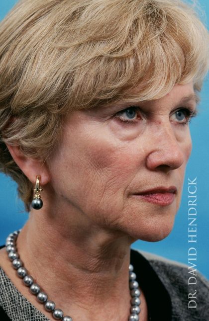 Facelift Before & After Patient #8903