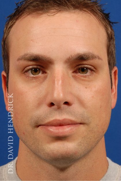 Rhinoplasty Before & After Patient #8995