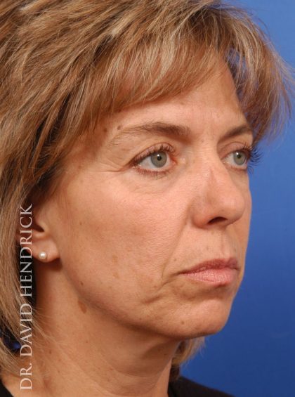 Deep Plane Facelift Before & After Patient #9002