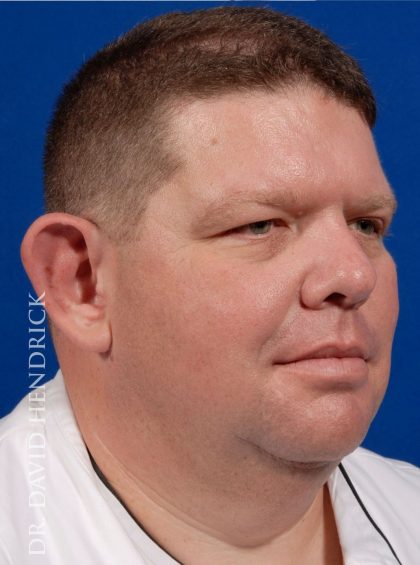 Otoplasty Before & After Patient #9007