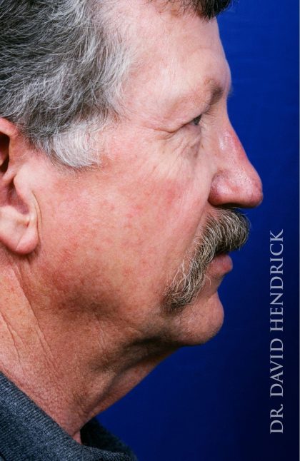 Neck Lift Before & After Patient #9014