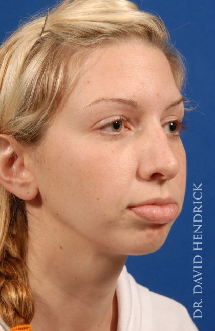 Face Implants Before & After Patient #8912