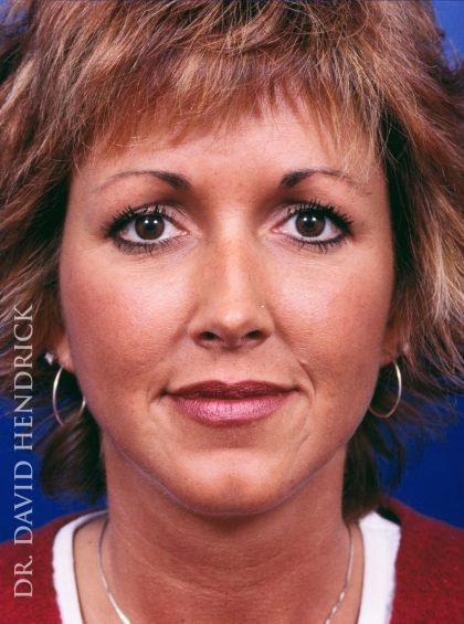 Rhinoplasty Before & After Patient #9019