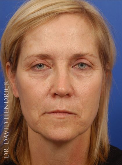 Deep Plane Facelift Before & After Patient #9026