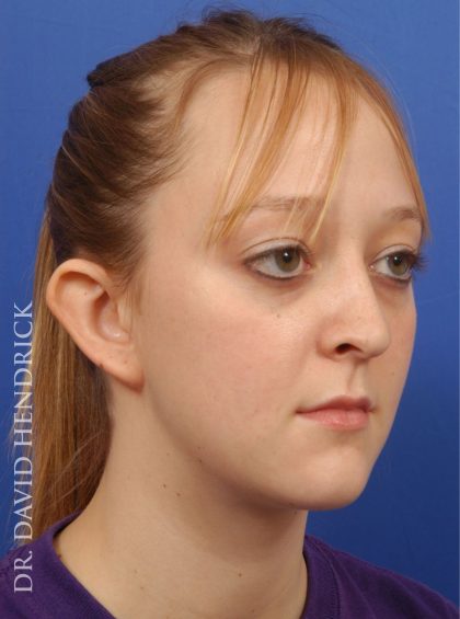 Otoplasty Before & After Patient #9031