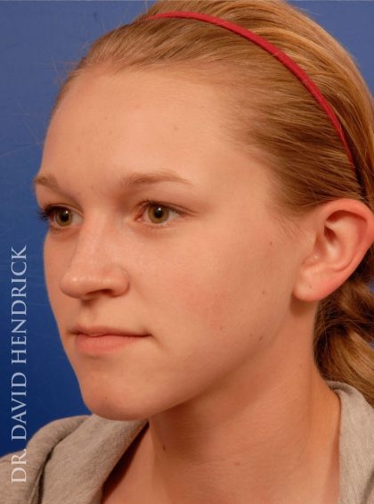 Otoplasty Before & After Patient #9038