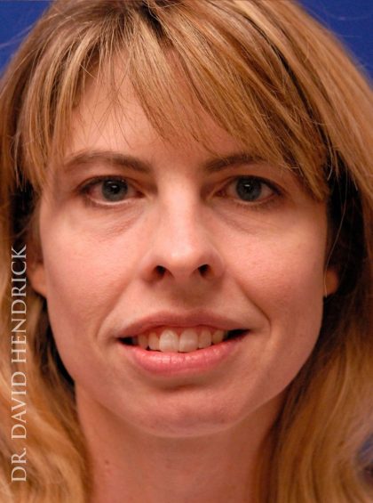 Rhinoplasty Before & After Patient #9045