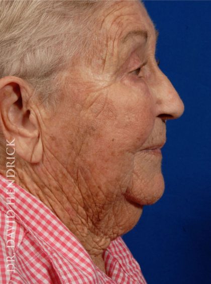 Neck Lift Before & After Patient #9052
