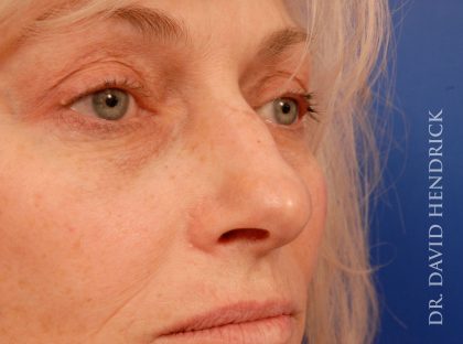 Deep Plane Facelift Before & After Patient #8936