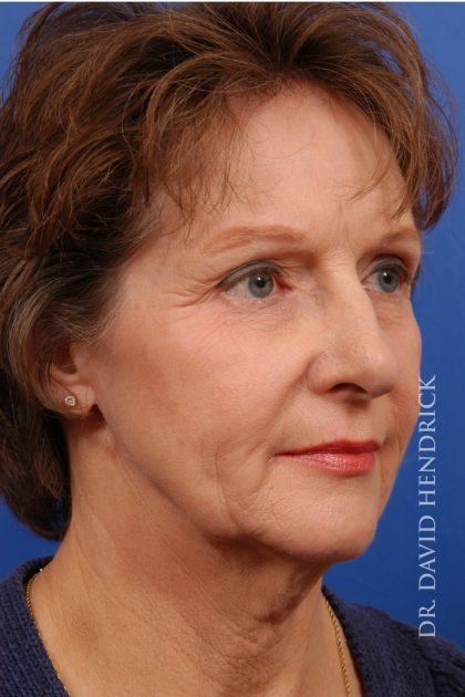 Facelift Before & After Patient #8847