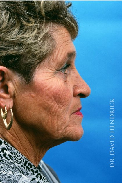 Facelift Before & After Patient #8840
