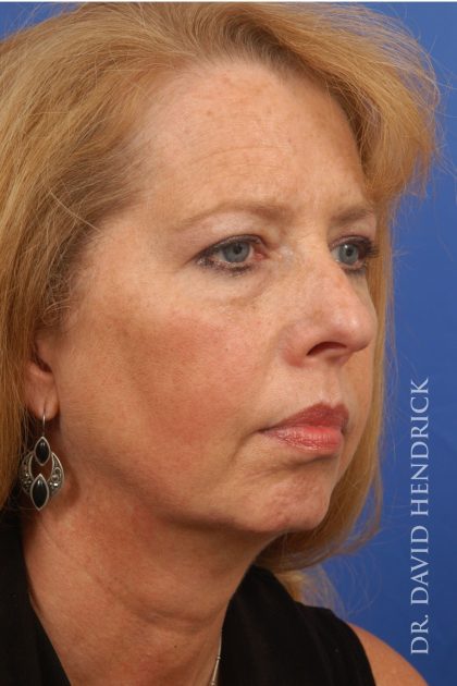 Face Implants Before & After Patient #8829