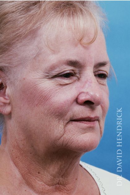 Facelift Before & After Patient #8819