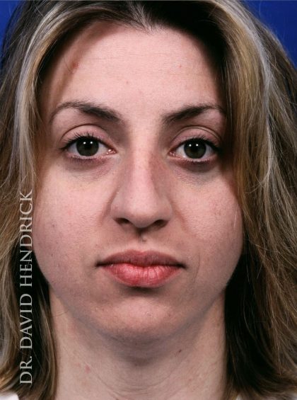 Face Implants Before & After Patient #8890