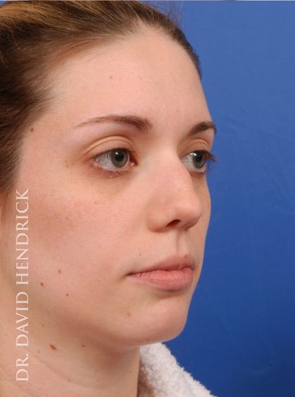 Face Implants Before & After Patient #8875