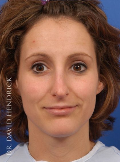 Rhinoplasty Before & After Patient #8941