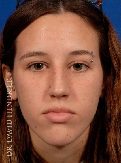 Rhinoplasty Before & After Patient #8948