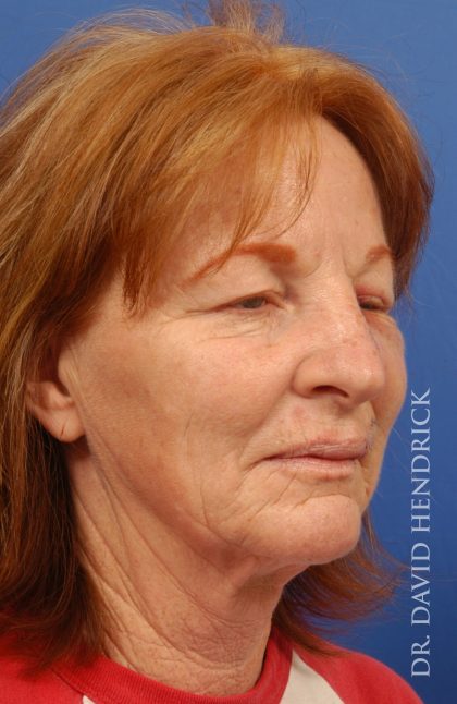 Facelift Before & After Patient #8859