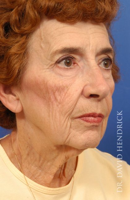 Facelift Before & After Patient #8884