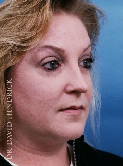 Rhinoplasty Before & After Patient #8967